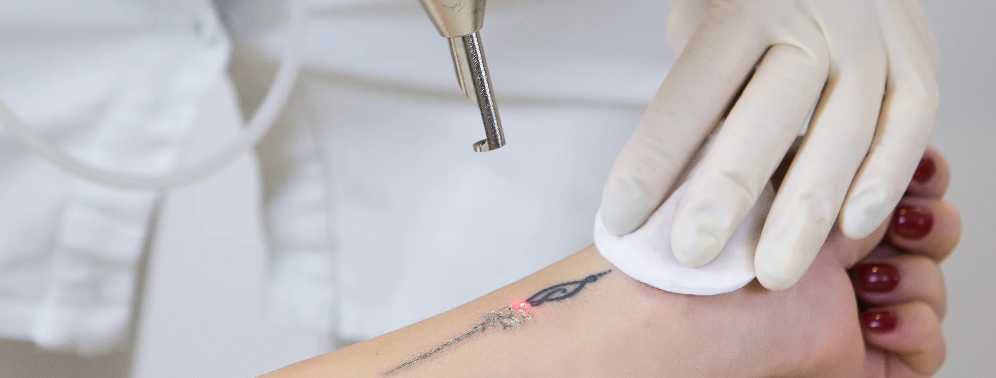 Remoção de tatuagem a laser saiba como funciona o procedimento e seus